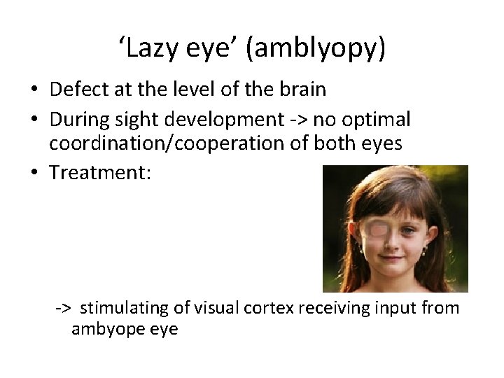 ‘Lazy eye’ (amblyopy) • Defect at the level of the brain • During sight