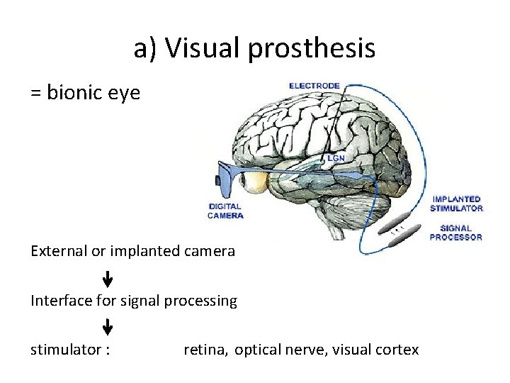 a) Visual prosthesis = bionic eye External or implanted camera Interface for signal processing