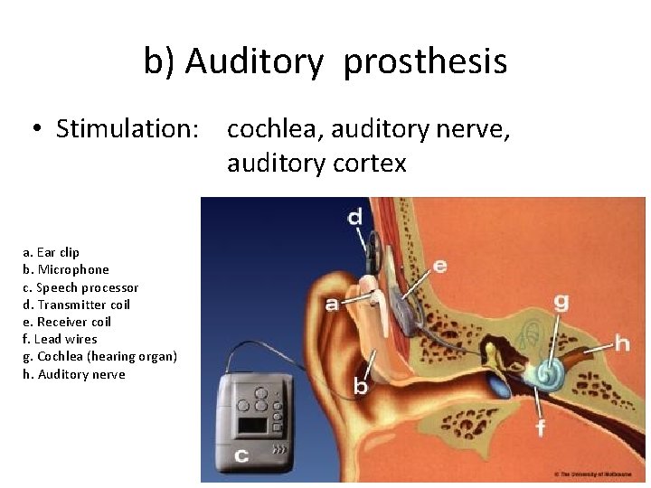 b) Auditory prosthesis • Stimulation: cochlea, auditory nerve, auditory cortex a. Ear clip b.