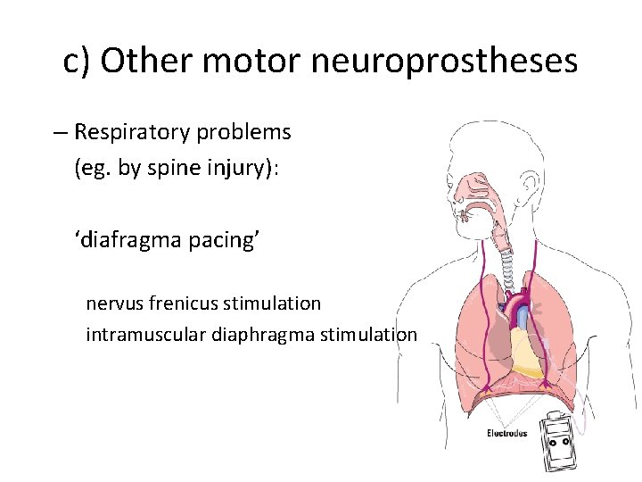 c) Other motor neuroprostheses – Respiratory problems (eg. by spine injury): ‘diafragma pacing’ nervus