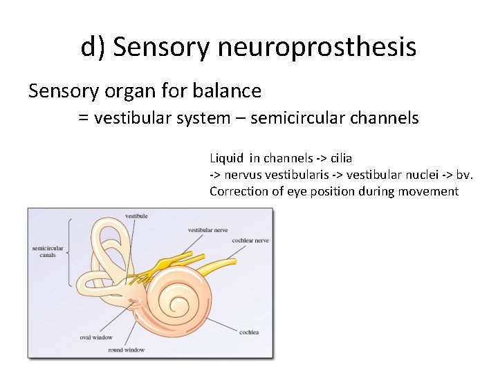 d) Sensory neuroprosthesis Sensory organ for balance = vestibular system – semicircular channels Liquid