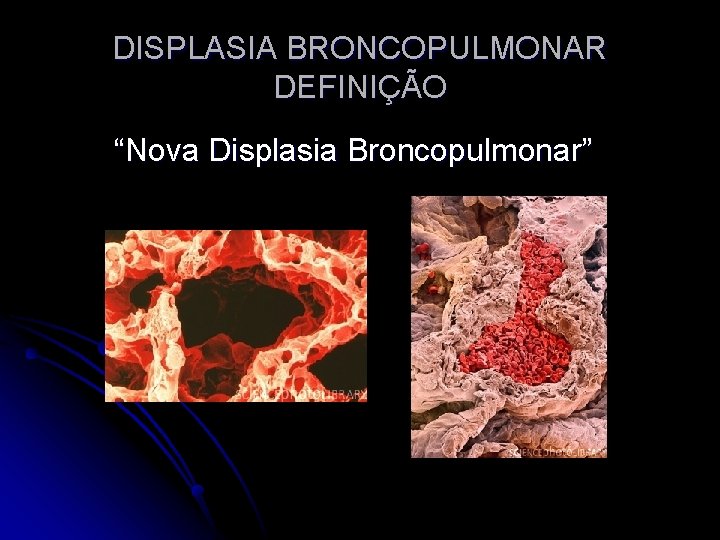 DISPLASIA BRONCOPULMONAR DEFINIÇÃO “Nova Displasia Broncopulmonar” 