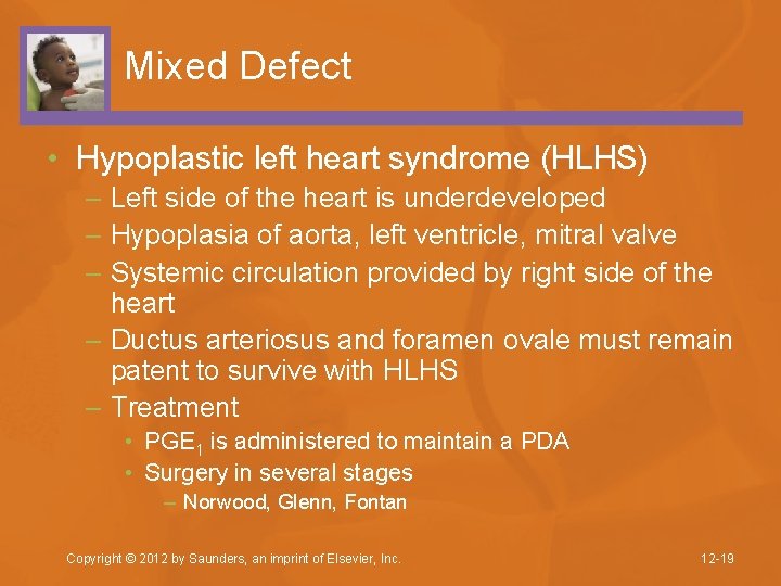 Mixed Defect • Hypoplastic left heart syndrome (HLHS) – Left side of the heart