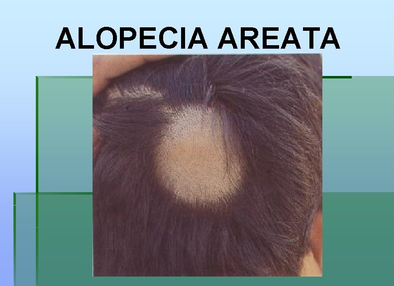 ALOPECIA AREATA 