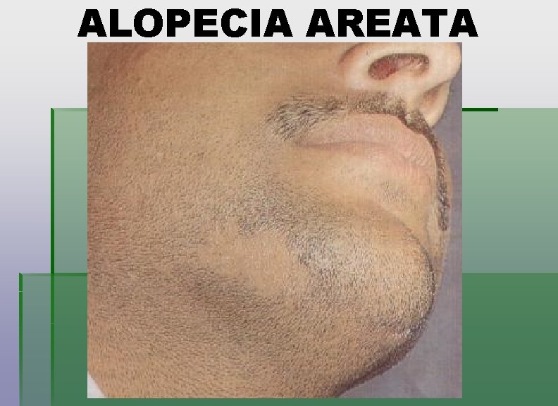 ALOPECIA AREATA 