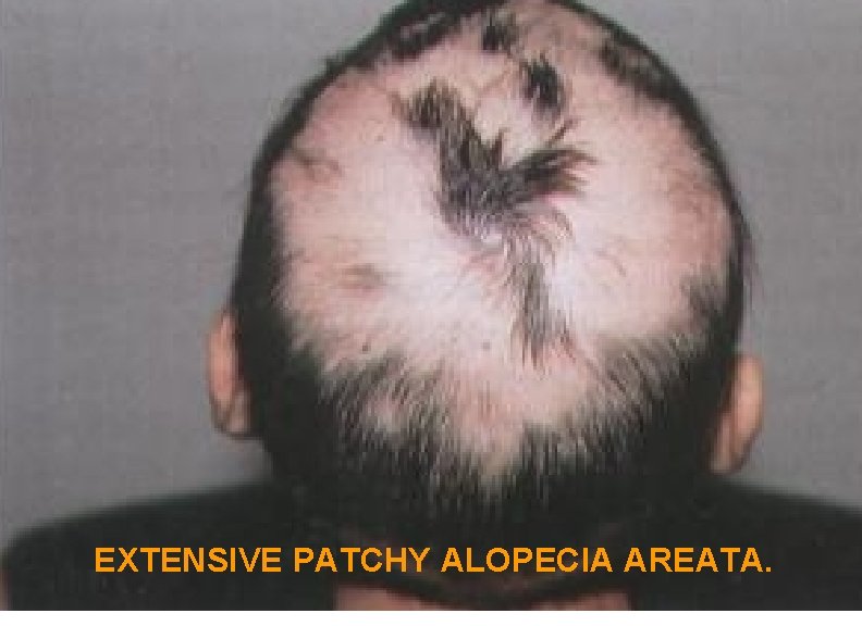 EXTENSIVE PATCHY ALOPECIA AREATA. 