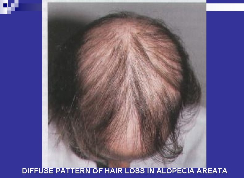 DIFFUSE PATTERN OF HAIR LOSS IN ALOPECIA AREATA 