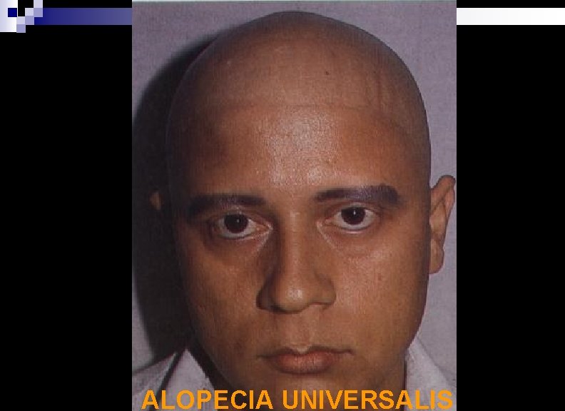 ALOPECIA UNIVERSALIS 