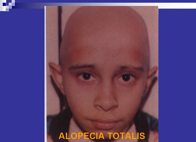 ALOPECIA TOTALIS 