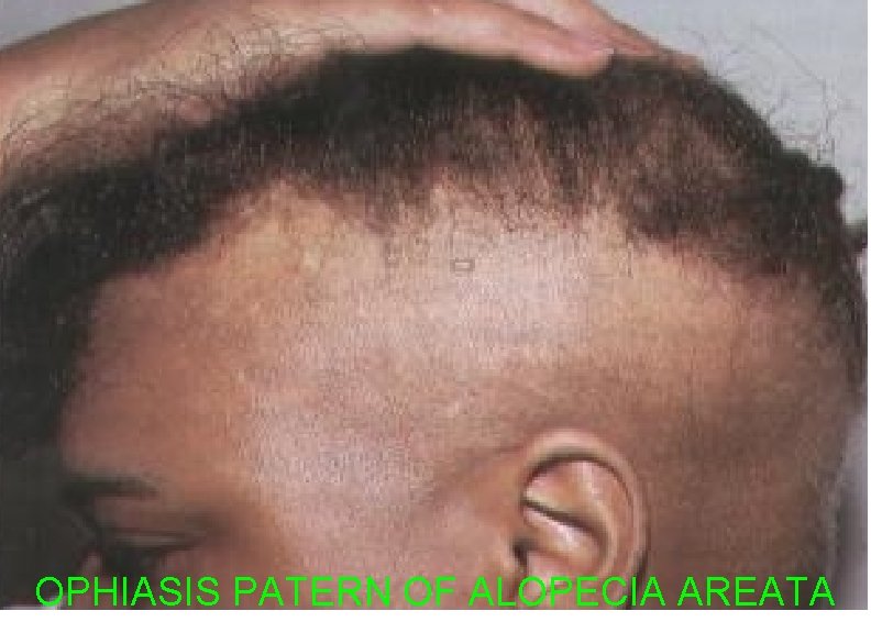 OPHIASIS PATERN OF ALOPECIA AREATA 