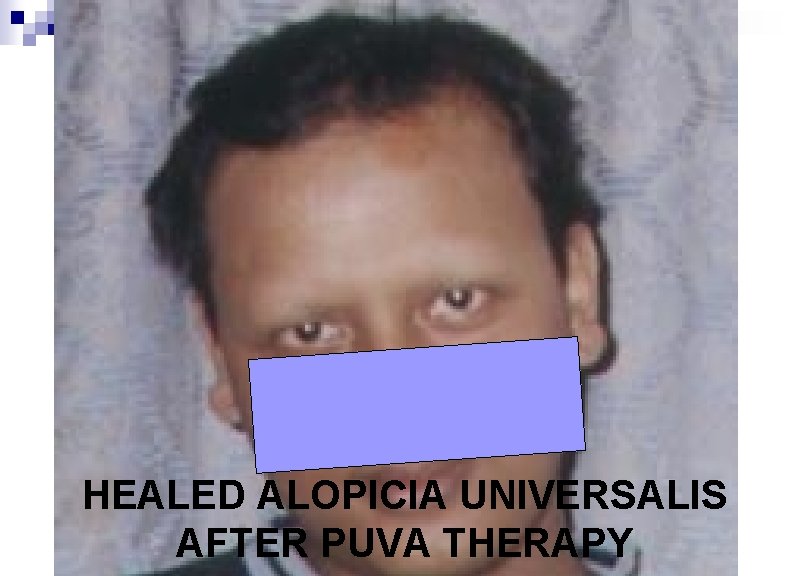 HEALED ALOPICIA UNIVERSALIS AFTER PUVA THERAPY 