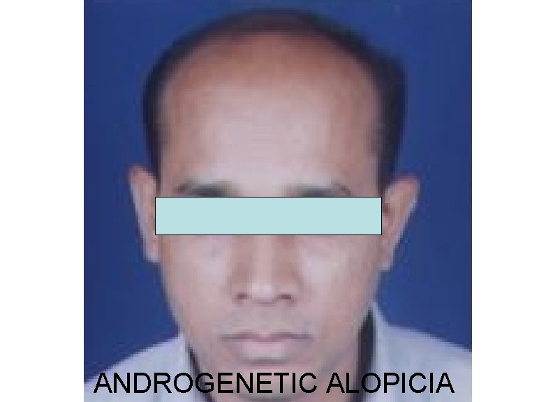 ANDROGENETIC ALOPICIA 