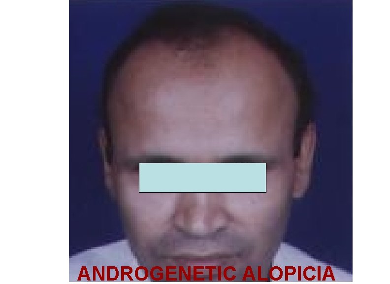 ANDROGENETIC ALOPICIA 