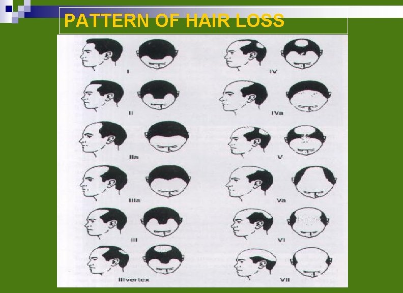 PATTERN OF HAIR LOSS 