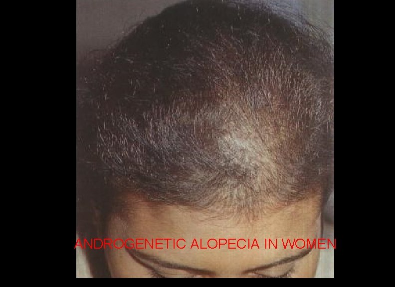 ANDROGENETIC ALOPECIA IN WOMEN 