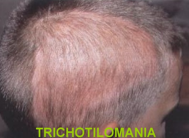 TRICHOTILOMANIA 