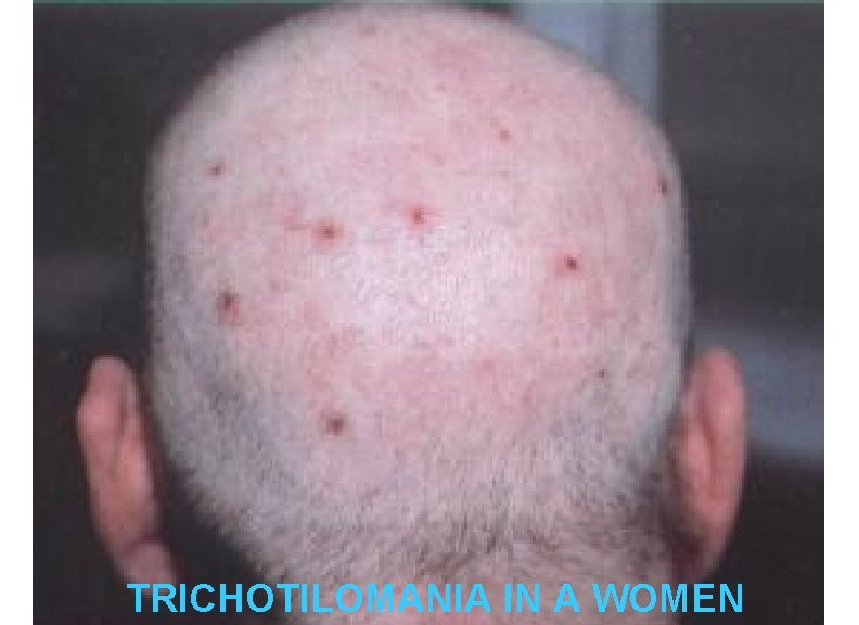 TRICHOTILOMANIA IN A WOMEN 