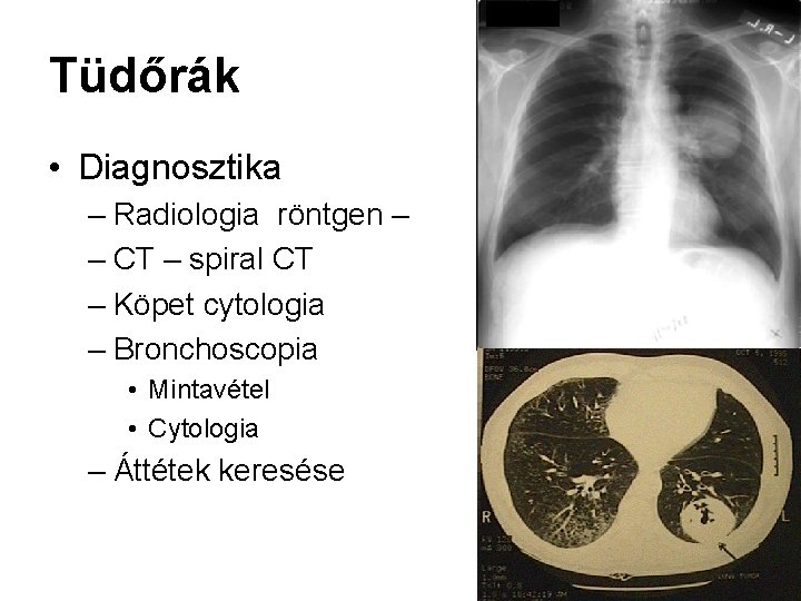 Tüdőrák • Diagnosztika – Radiologia röntgen – – CT – spiral CT – Köpet