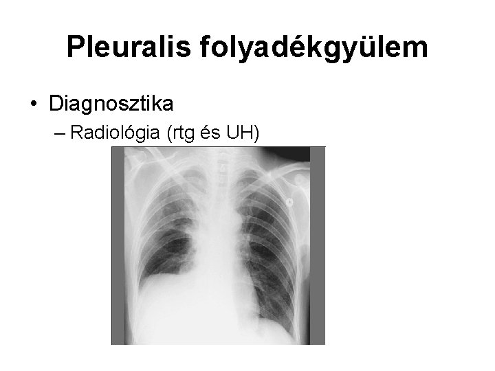 Pleuralis folyadékgyülem • Diagnosztika – Radiológia (rtg és UH) 