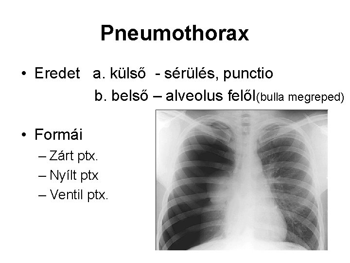 Pneumothorax • Eredet a. külső - sérülés, punctio b. belső – alveolus felől(bulla megreped) Pneumothorax • Eredet a. külső - sérülés, punctio b. belső – alveolus felől(bulla megreped)