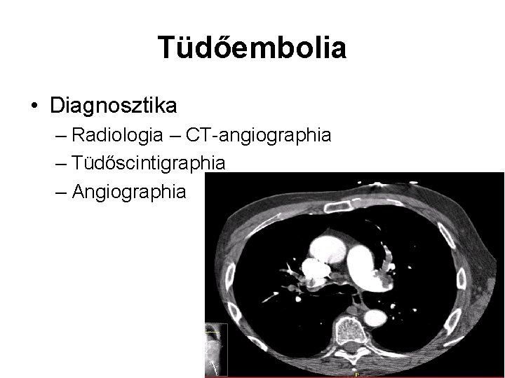 Tüdőembolia • Diagnosztika – Radiologia – CT-angiographia – Tüdőscintigraphia – Angiographia 