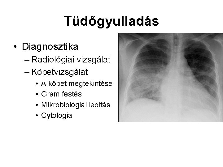 Tüdőgyulladás • Diagnosztika – Radiológiai vizsgálat – Köpetvizsgálat • • A köpet megtekintése Gram Tüdőgyulladás • Diagnosztika – Radiológiai vizsgálat – Köpetvizsgálat • • A köpet megtekintése Gram