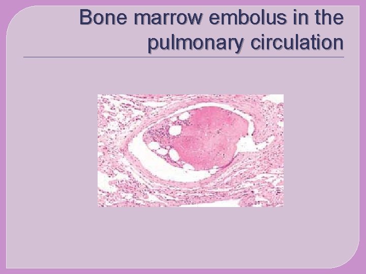  Bone marrow embolus in the pulmonary circulation 