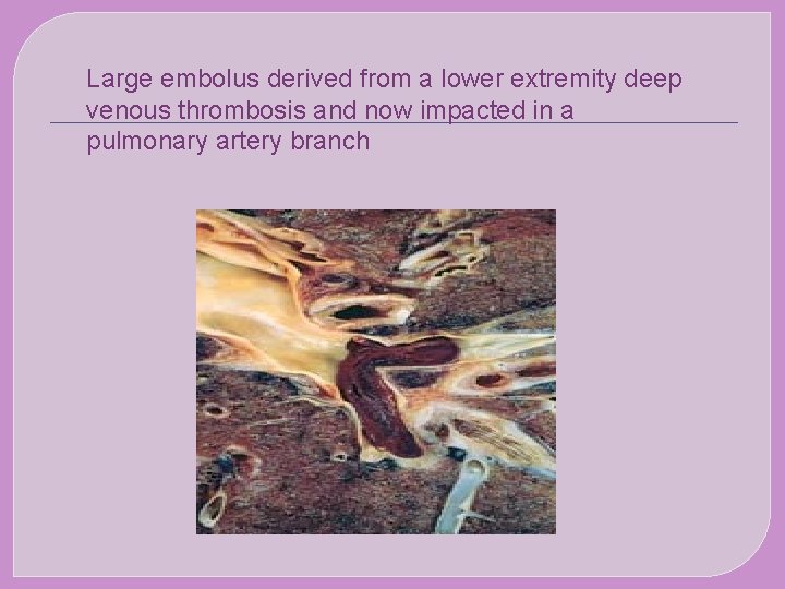 Large embolus derived from a lower extremity deep venous thrombosis and now impacted in