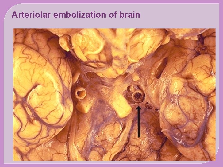 Arteriolar embolization of brain 