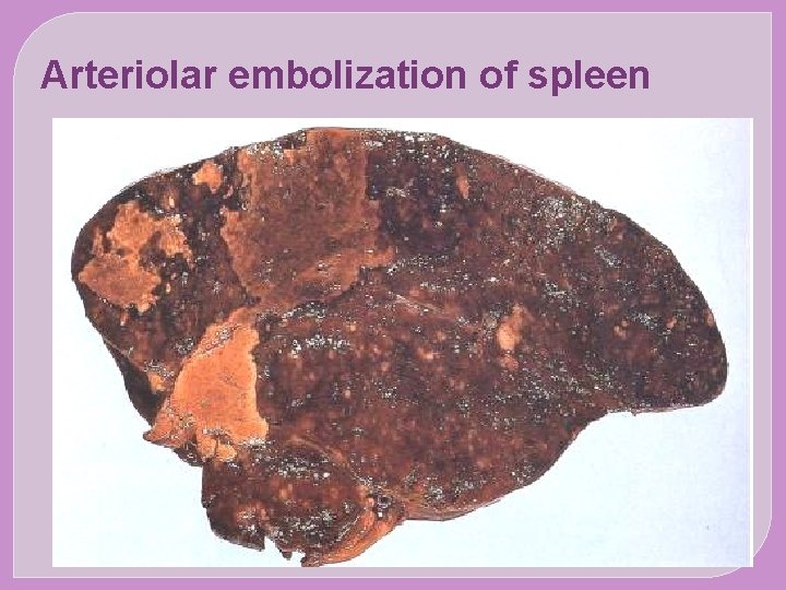 Arteriolar embolization of spleen 