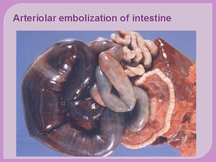 Arteriolar embolization of intestine 