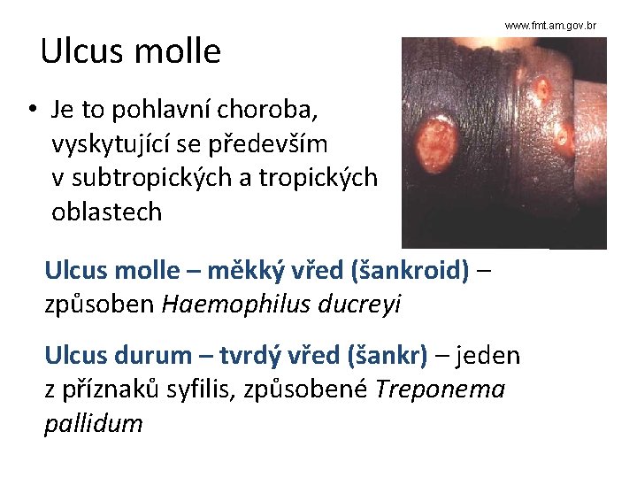 Ulcus molle www. fmt. am. gov. br • Je to pohlavní choroba, vyskytující se