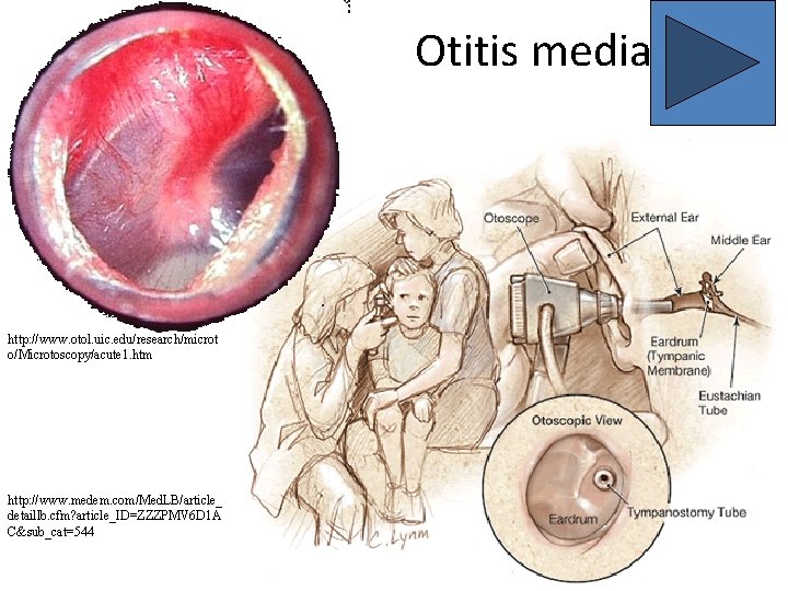 Otitis media http: //www. otol. uic. edu/research/microt o/Microtoscopy/acute 1. htm http: //www. medem. com/Med.