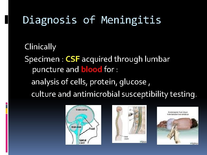 Diagnosis of Meningitis Clinically Specimen : CSF acquired through lumbar puncture and blood for