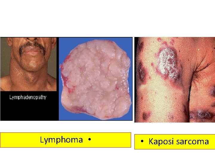 Lymphoma • • Kaposi sarcoma 