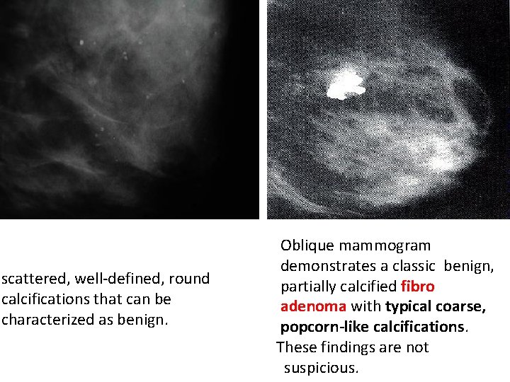scattered, well-defined, round calcifications that can be characterized as benign. Oblique mammogram demonstrates a