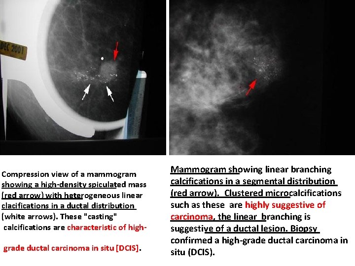 Compression view of a mammogram showing a high-density spiculated mass (red arrow) with heterogeneous