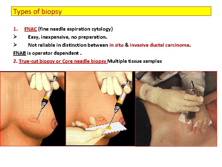 Types of biopsy 1. FNAC (fine needle aspiration cytology) Ø Easy, inexpensive, no preparation.