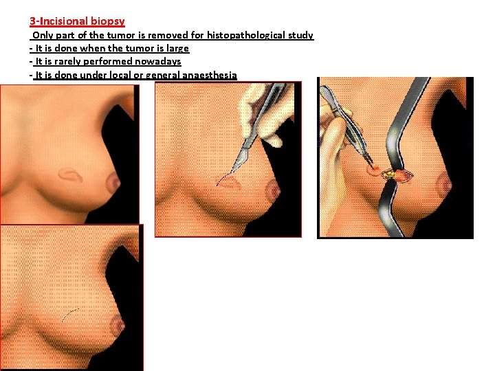 3 -Incisional biopsy Only part of the tumor is removed for histopathological study -