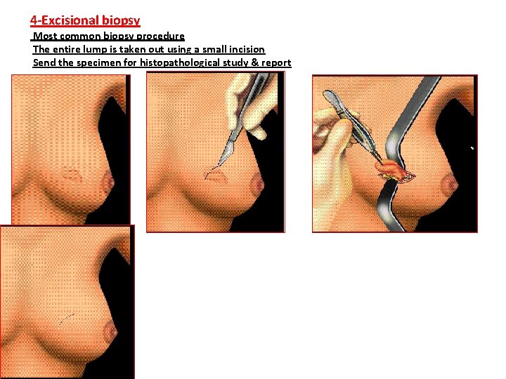 4 -Excisional biopsy Most common biopsy procedure The entire lump is taken out using