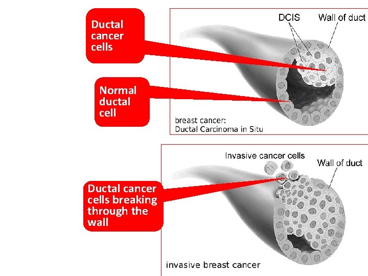 Ductal cancer cells Normal ductal cell Ductal cancer cells breaking through the wall 5