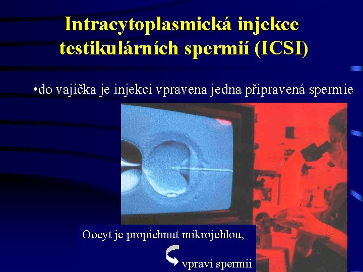 Intracytoplasmická injekce testikulárních spermií (ICSI) • do vajíčka je injekcí vpravena jedna připravená spermie