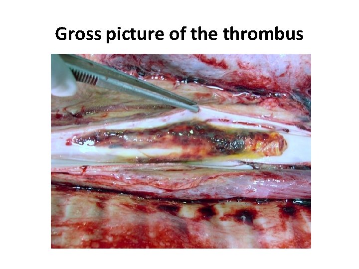 Gross picture of the thrombus 