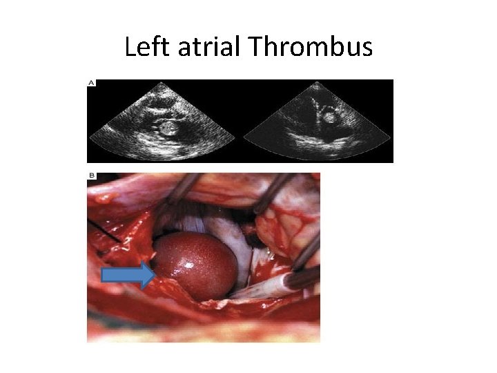 Left atrial Thrombus 