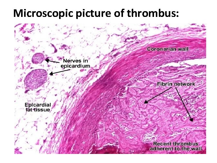 Microscopic picture of thrombus: 