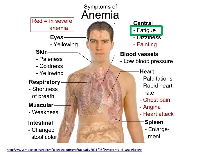 http: //www. medexpressrx. com/blog/wp-content/uploads/2011/06/Symptoms_of_anemia. png 