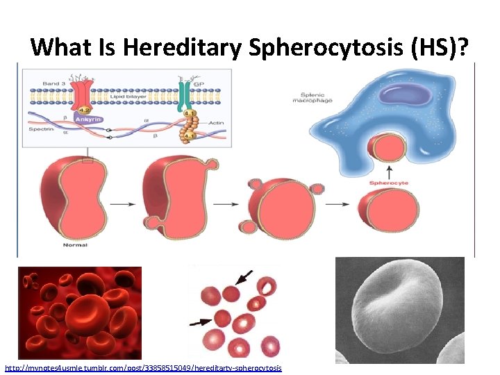 What Is Hereditary Spherocytosis (HS)? http: //mynotes 4 usmle. tumblr. com/post/33858515049/hereditarty-spherocytosis 