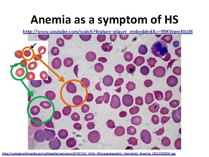 Anemia as a symptom of HS http: //www. youtube. com/watch? feature=player_embedded&v=88 KWpm. Kt. UJ