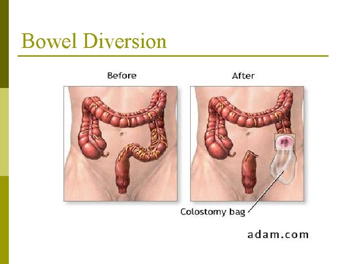 Bowel Diversion Bowel Diversion