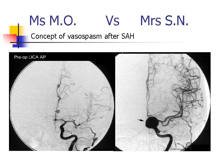 Ms M. O. Vs Concept of vasospasm after SAH Mrs S. N. 